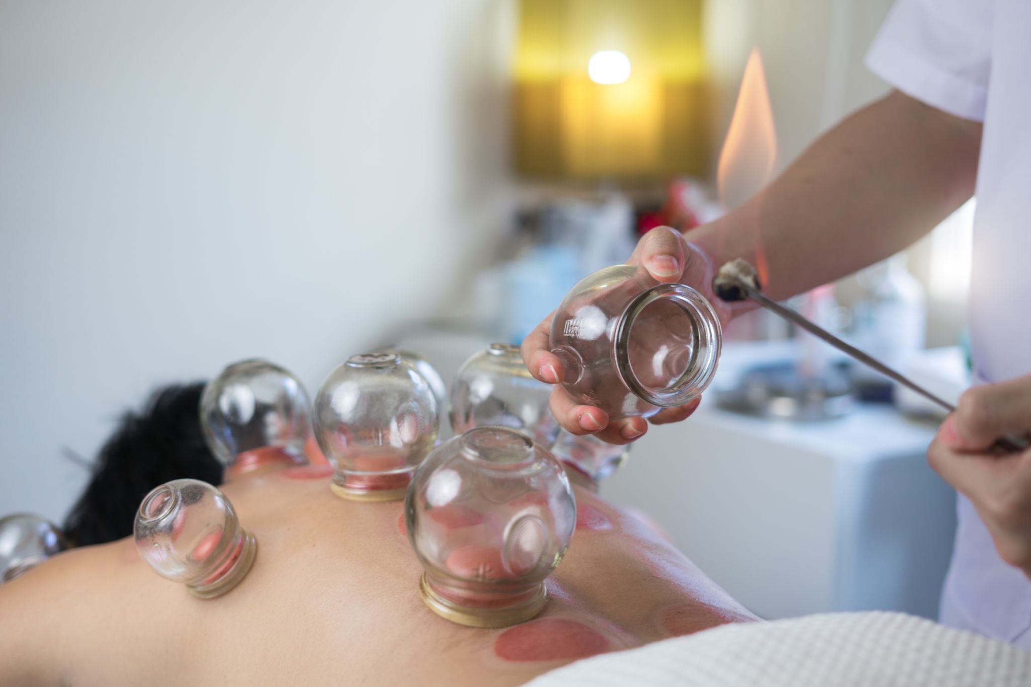 Dry Fire Cupping